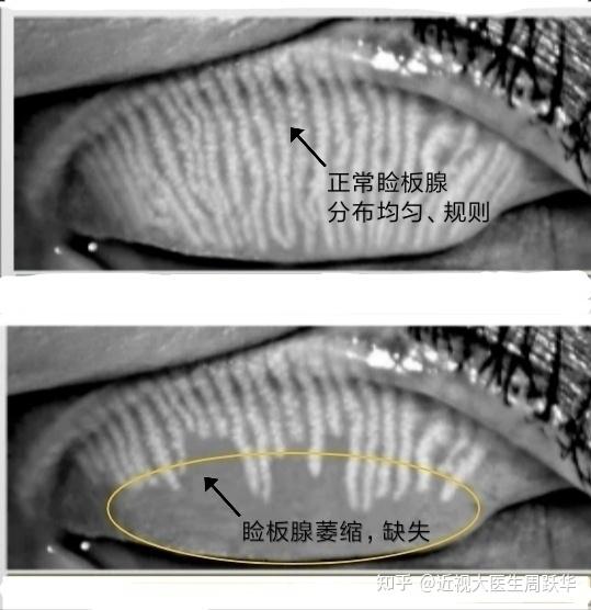 睑板腺拍照标准图片图片