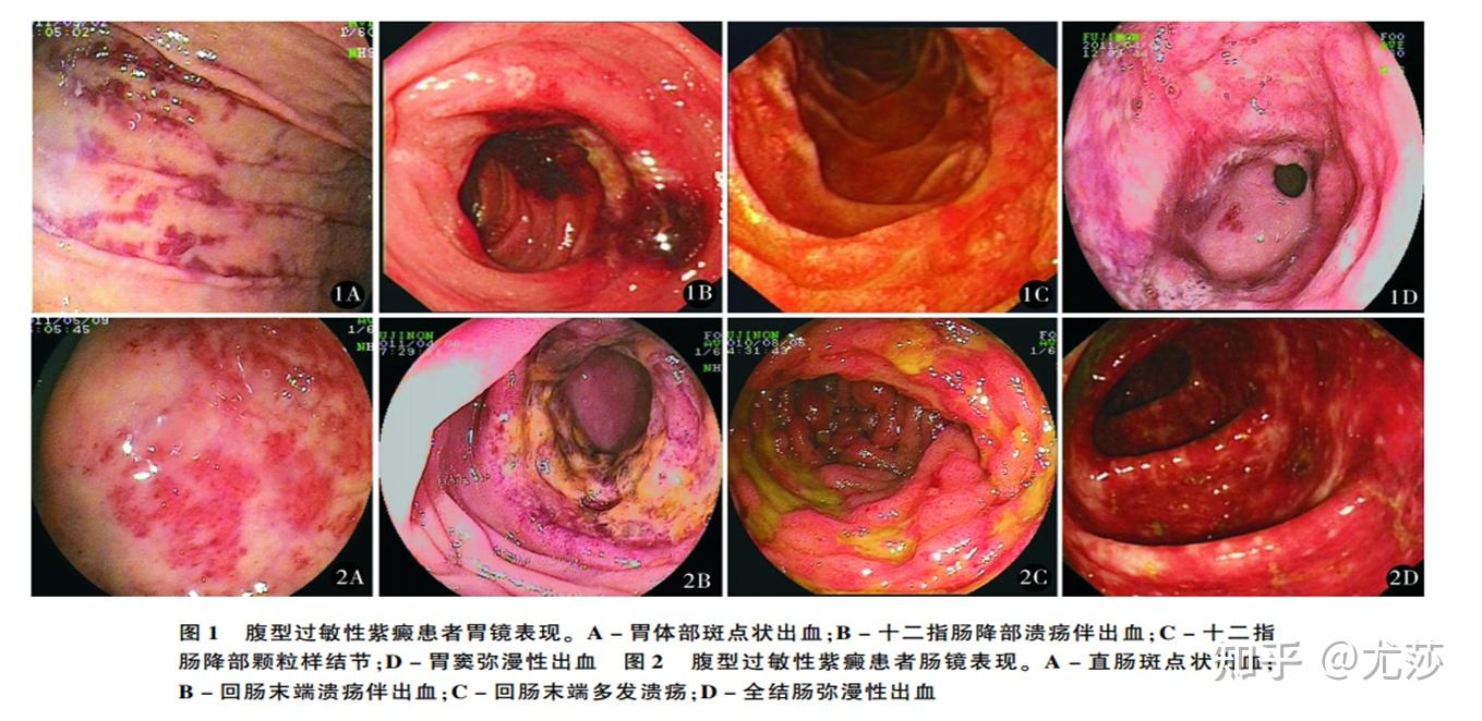 广泛性小血管无菌性炎症61临床主要表现:皮肤紫癜,腹痛和消化道出血