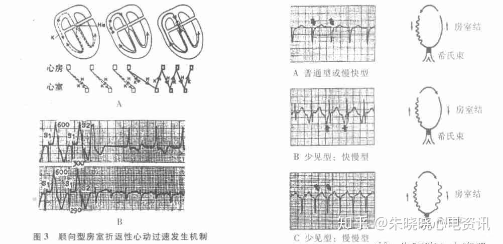 然后激动再次经房室结前传心室时,周而复始,产生了顺向型房室折返性