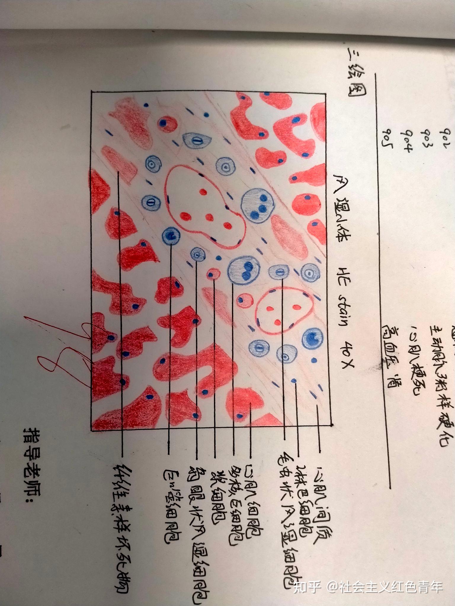 10大叶性肺炎(灰色肝变期)11硅肺硅结节12溃疡13肝硬化