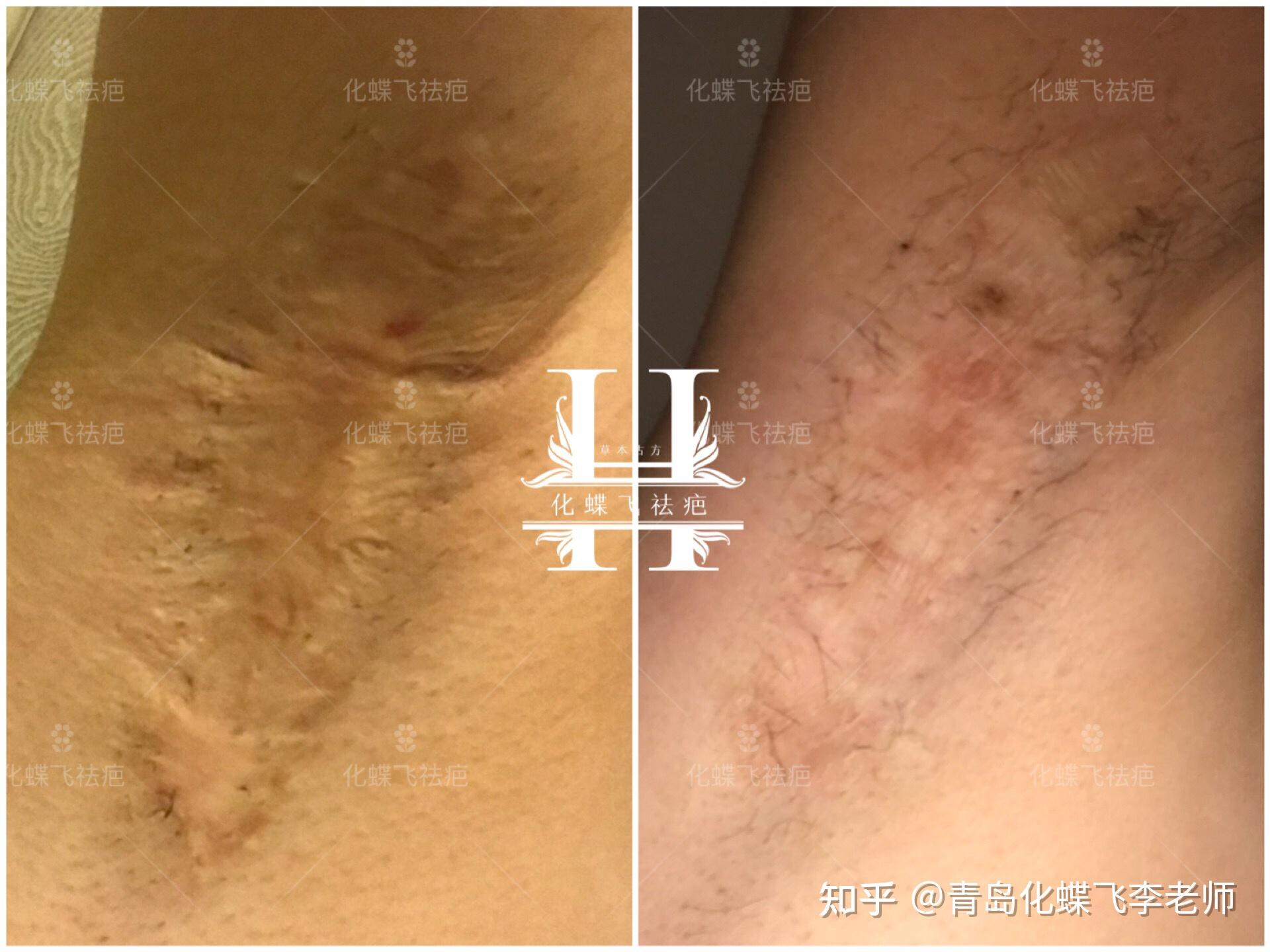 钙化严重的腋下手术疤痕