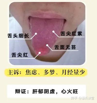 “阴虚火旺”危害大!具体有哪些症状?中医吃什么调理最好? - 知乎