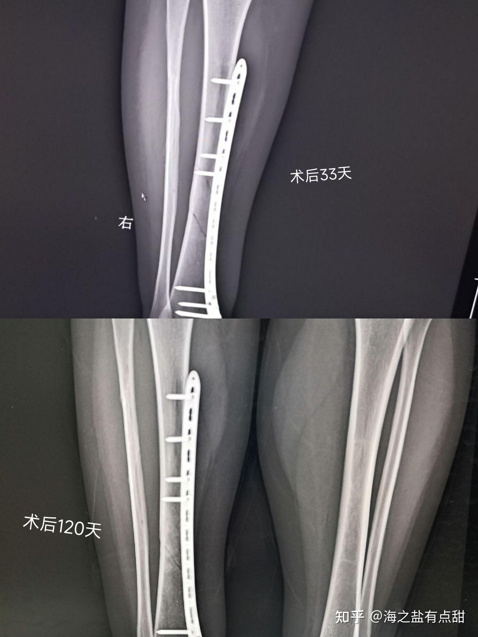 記錄小腿脛腓骨骨折經歷