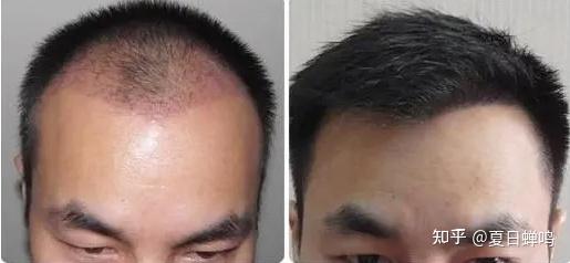 植发可以保持多久，后面需要重新植发吗？植发哪里好？ - 知乎