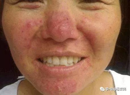 美容院内最易被误诊的玫瑰痤疮