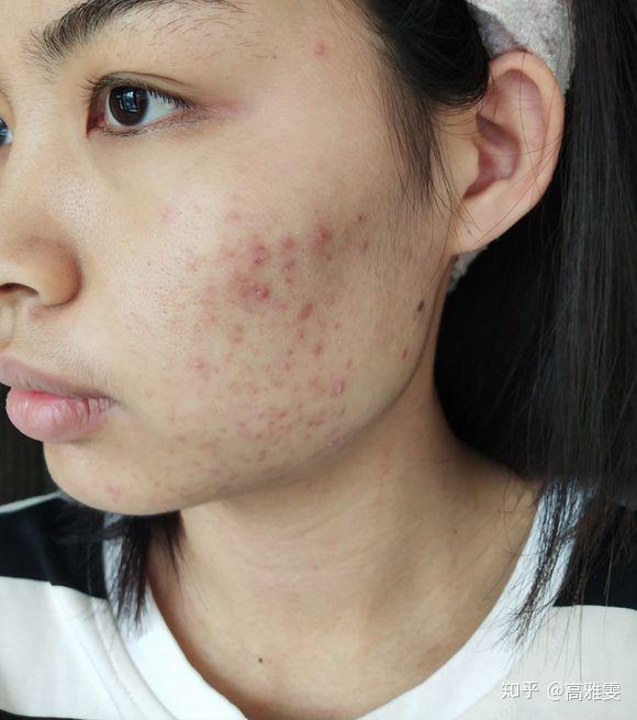 脸上痘痘很多毛孔堵塞严重每一个毛孔都可以挤出黄白色的油脂粒怎么办