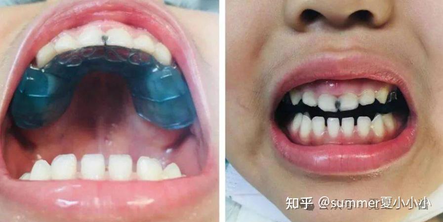 舌头贴上颚,能让鼻基底变高、脸变立体变好看? - 知乎