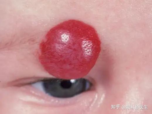 小儿常见的眼睑良性肿瘤