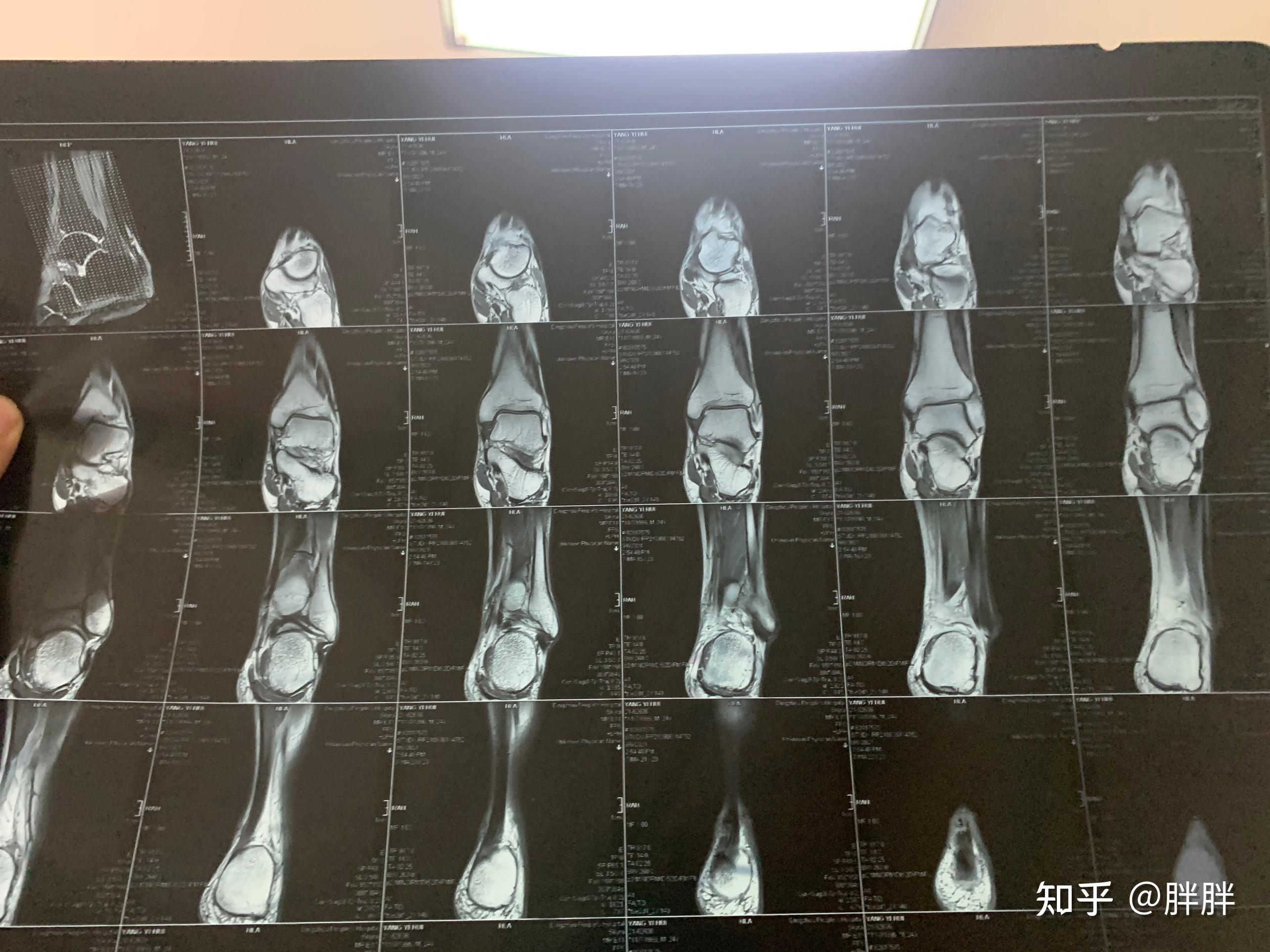 核磁共振跟腱断裂图图片