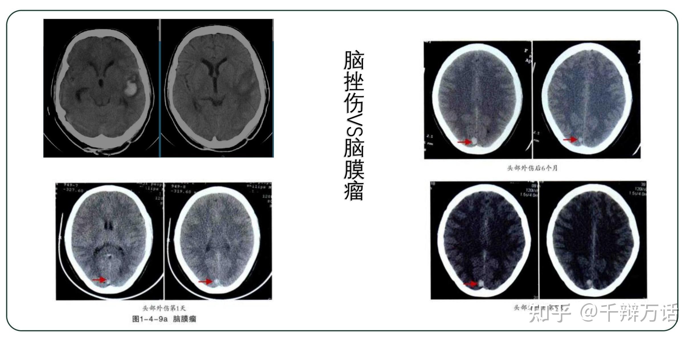 3 脑萎缩误认定为硬膜下积液脑萎缩时,其相应部位脑沟及脑裂亦相应