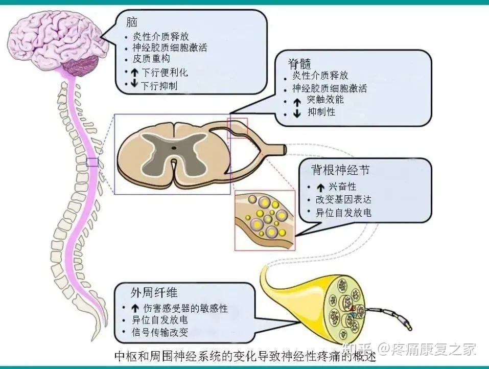 帶狀皰疹後神經痛到底與什麼因素有關? - 知乎