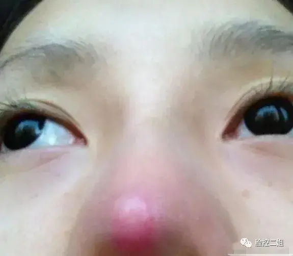 线雕隆鼻所使用的线是一种带双向倒刺的高硬度可吸收的线,使得鼻子变