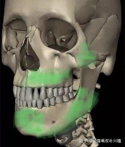 凸嘴 双鄂正颌整形手术的59个真相 知乎