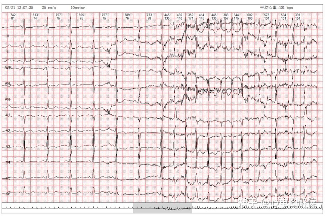 今天要分享的心电图67——阵发性房颤,室早二联律