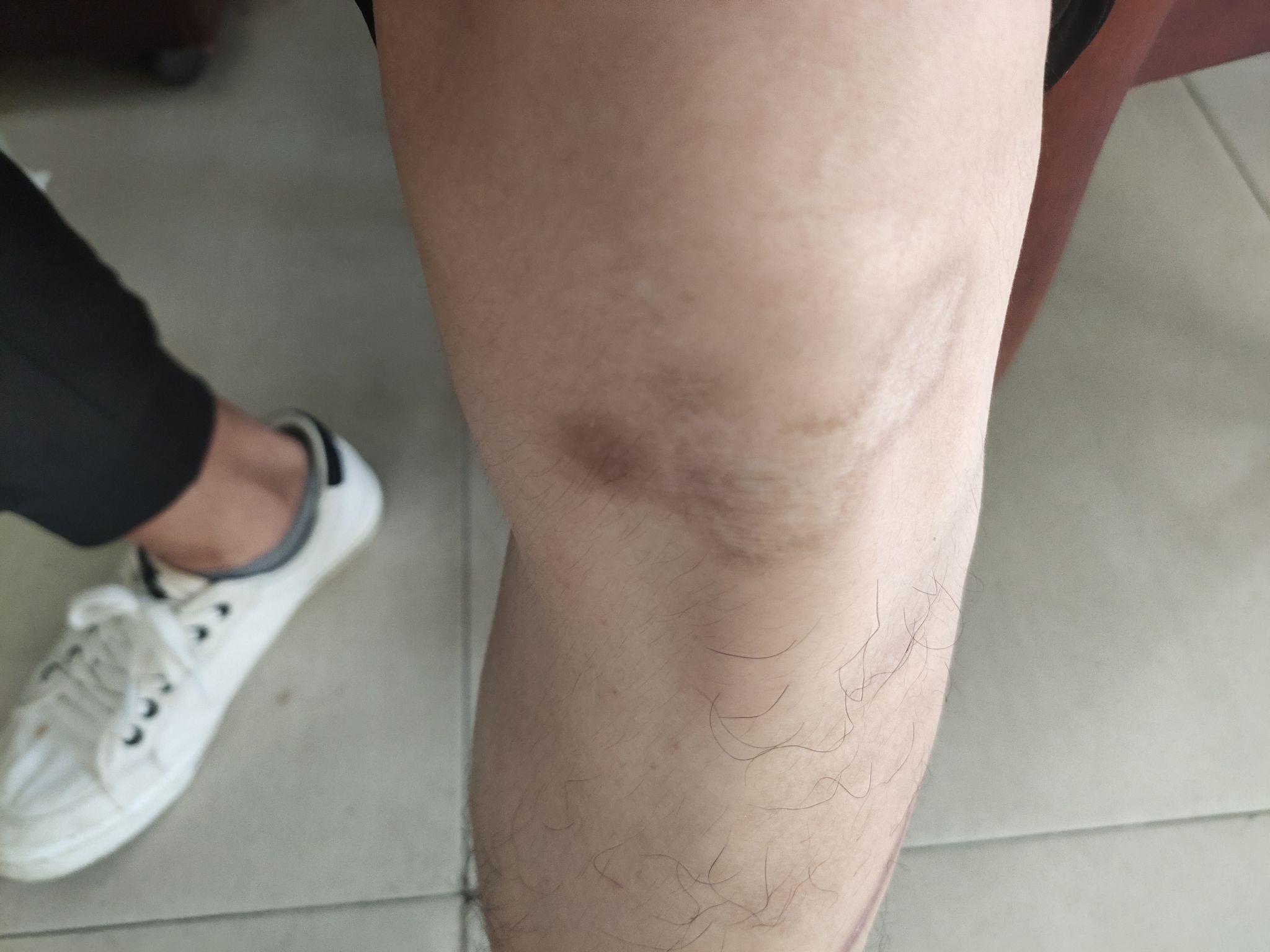 膝盖大面积擦伤