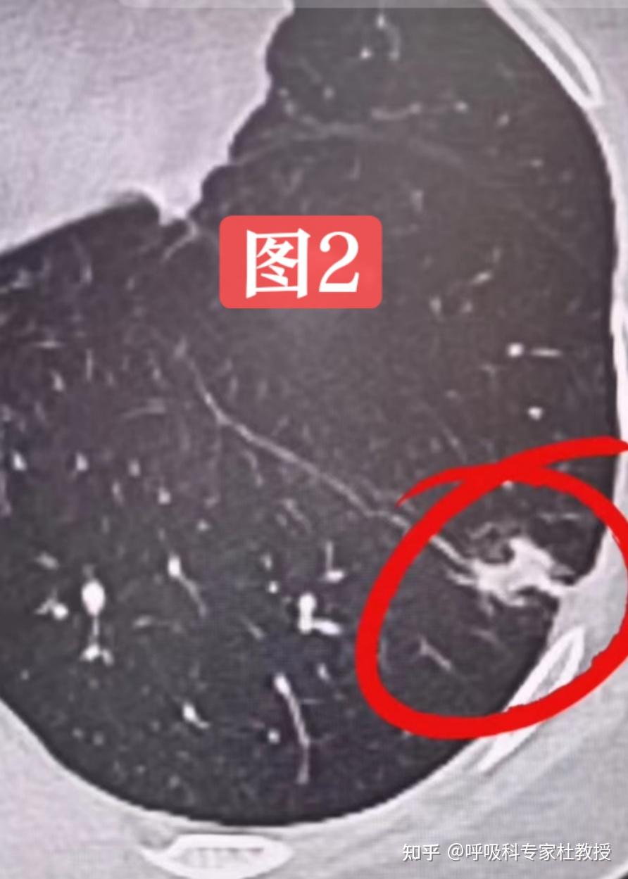 肺结节出现【胸膜牵拉】就确定肿瘤?