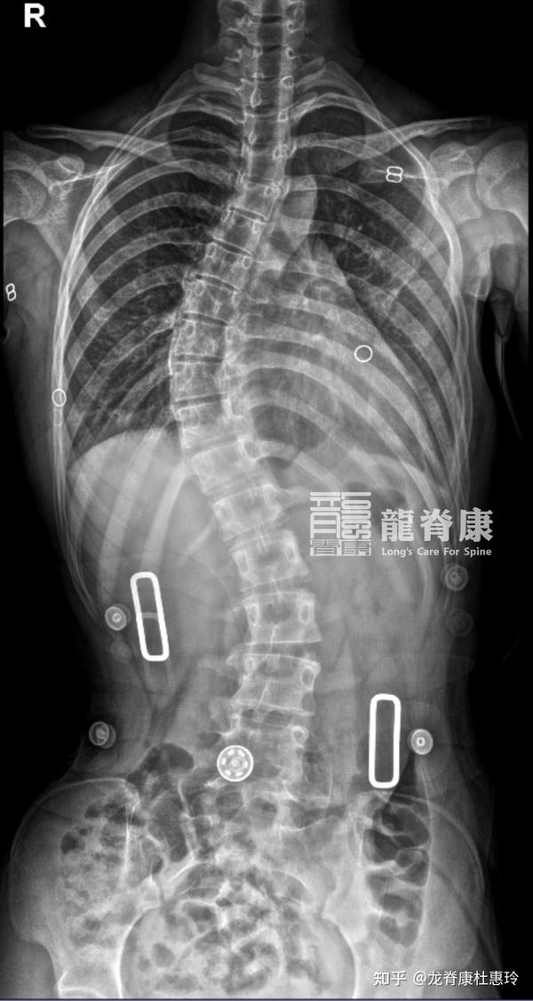脊柱侧弯要上心,角度增大不留情! - 知乎