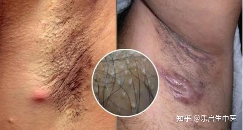 腋臭取出的汗腺图片图片