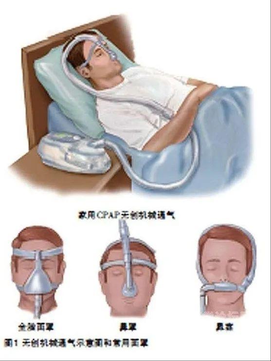 气管切开)进行的正压机械通气方式,无创呼吸机是指通过口鼻罩,鼻罩,鼻