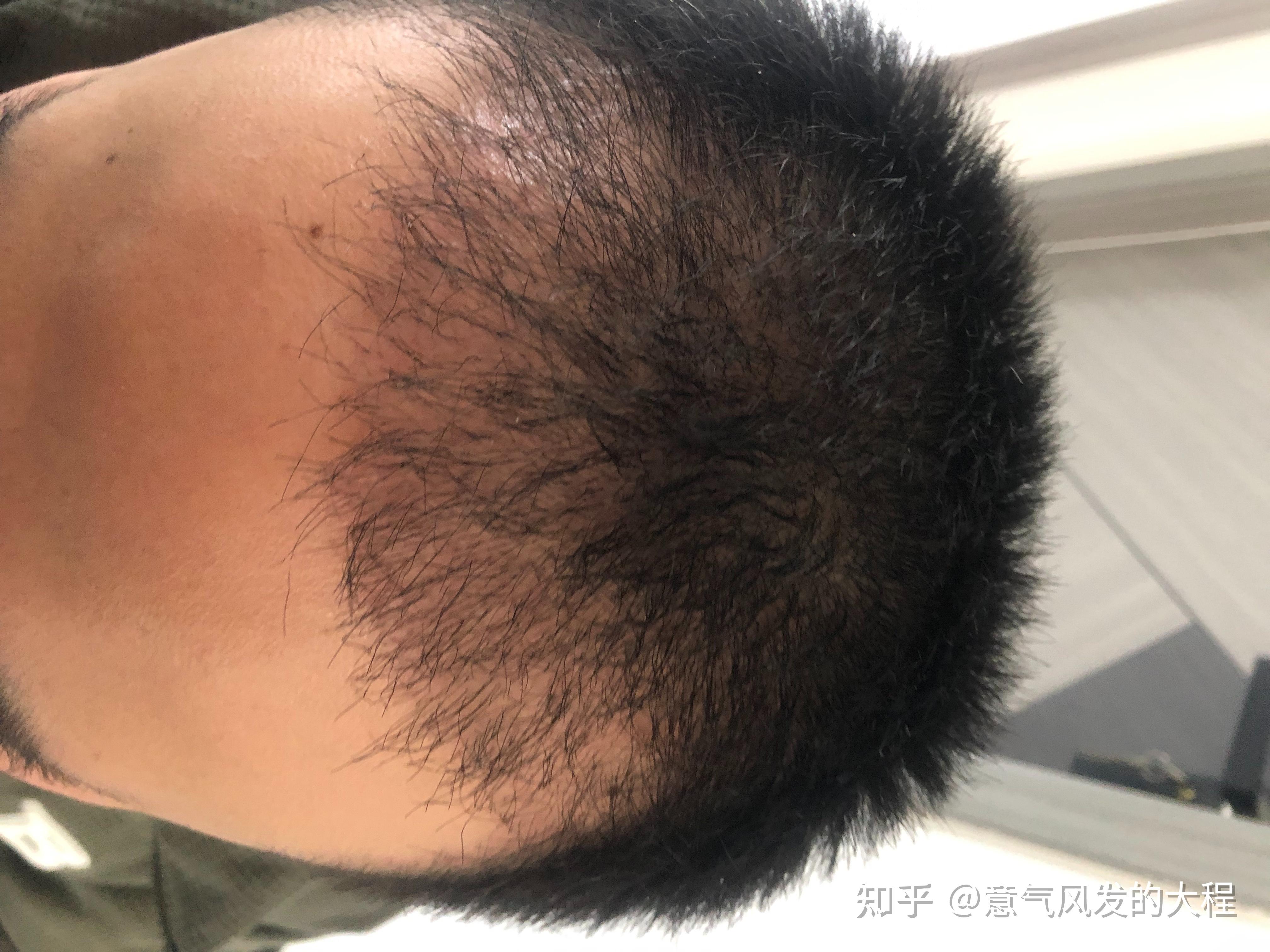 植发渗出的液体(植发后渗出液是什么)