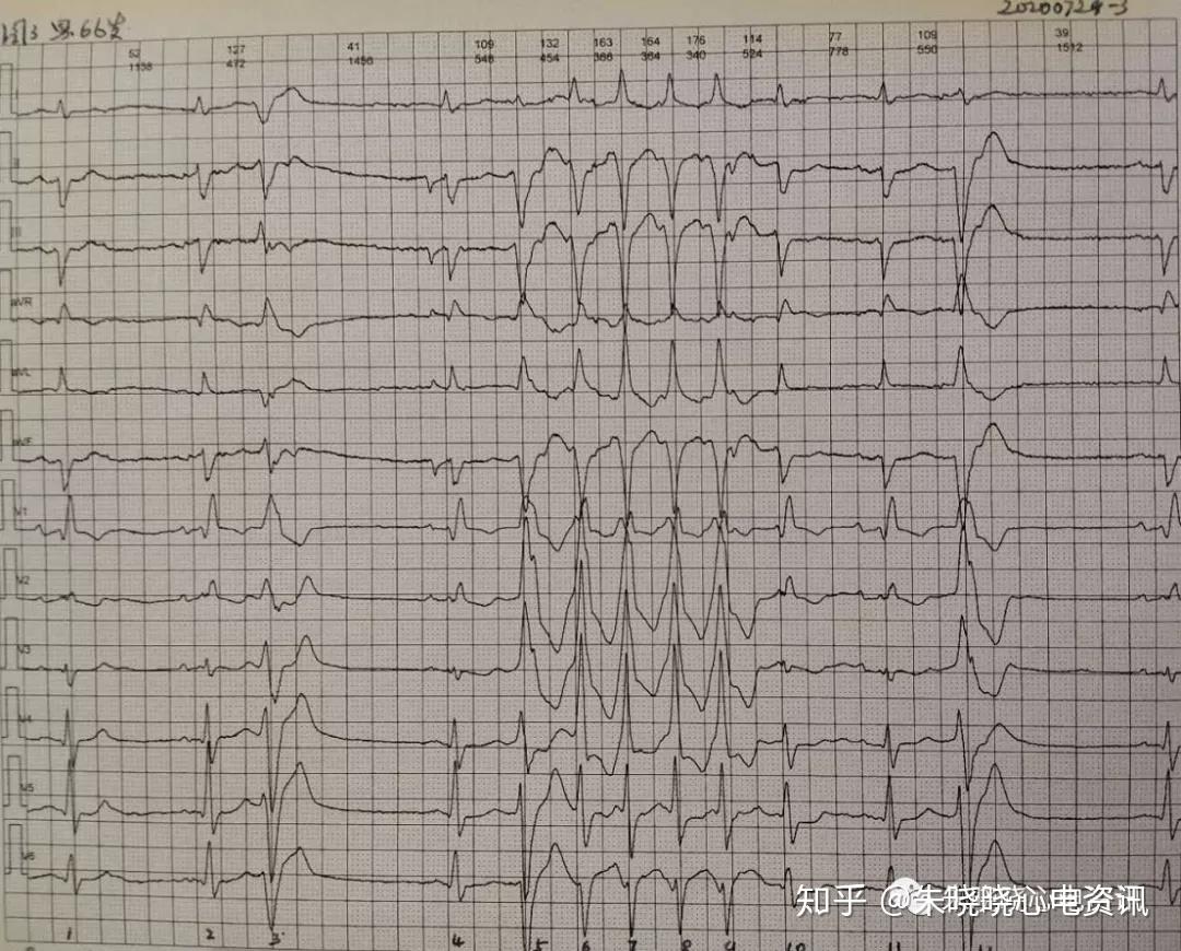 盧老師看心電圖交界性逸搏多源室性早搏二聯律6767672020729