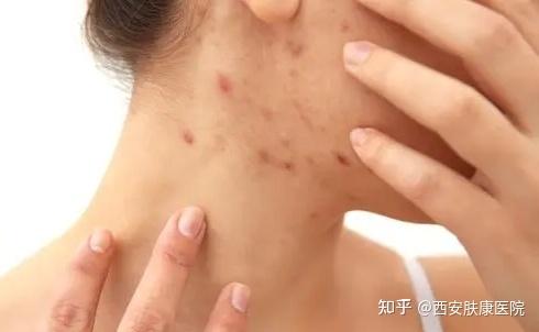 扁平疣是怎么引起的?怎么样治疗? - 知乎