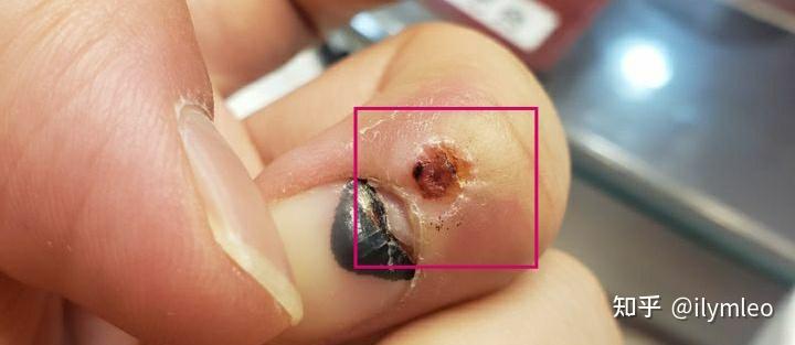 分享自己寻常疣的治疗过程 - 知乎