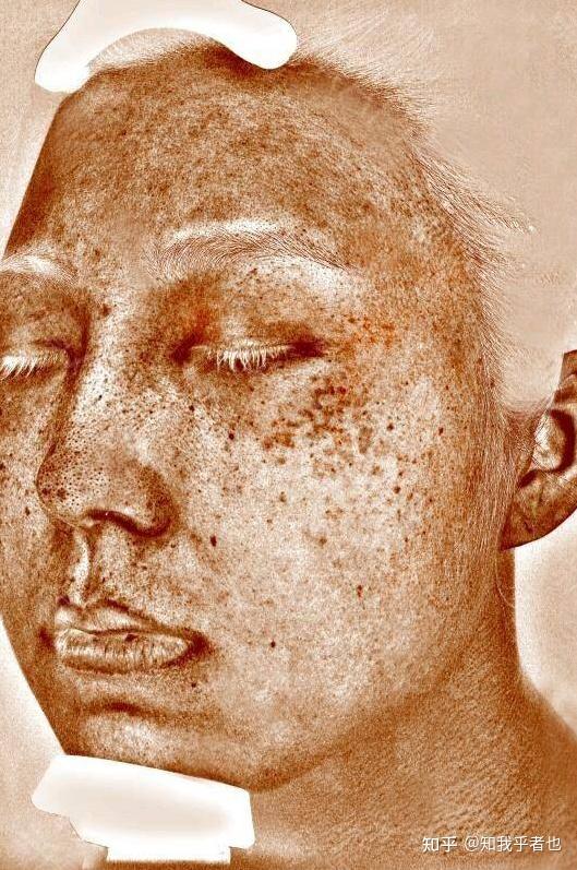 阿源达人教你预防斑点的黄金守则应对脸上长斑怎么办