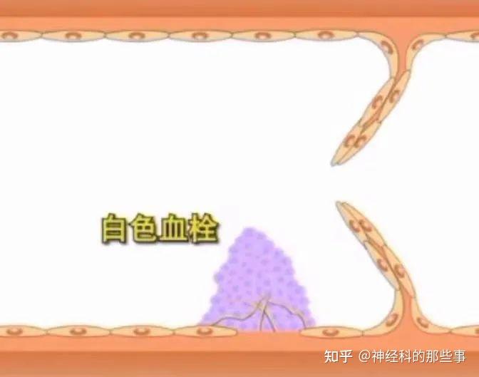 血栓形成的病理过程 - 知乎