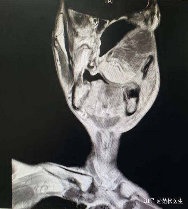 病例分享丨鼻咽癌放疗诱导的左上颌颅底骨肉瘤 - 知乎