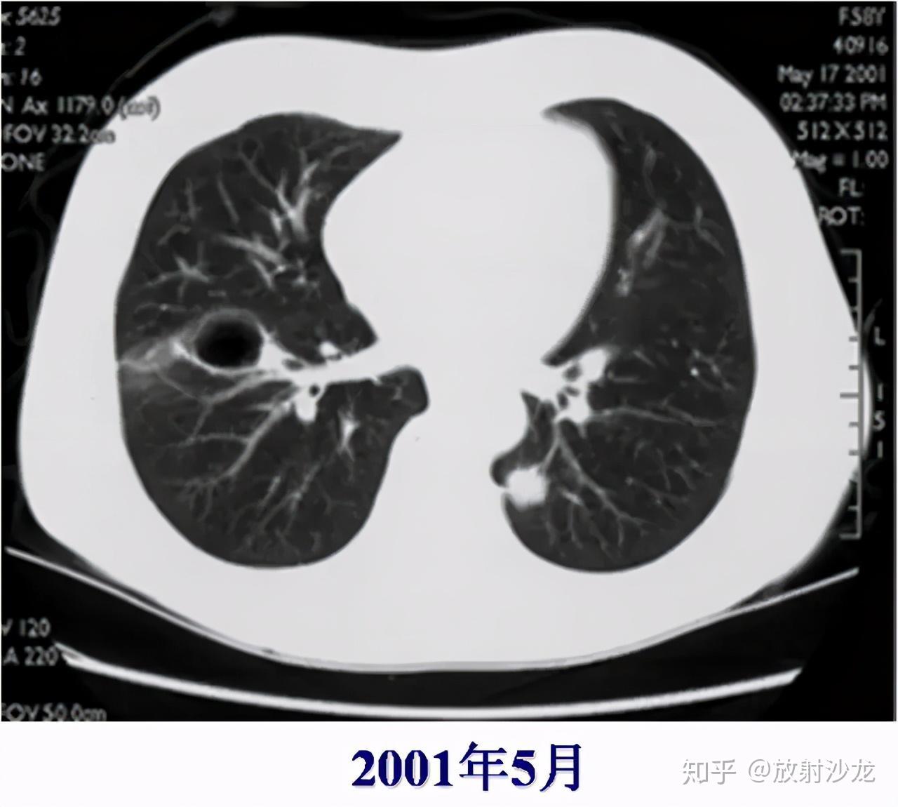 这十大肺部ct征像,一定有你不知道的!