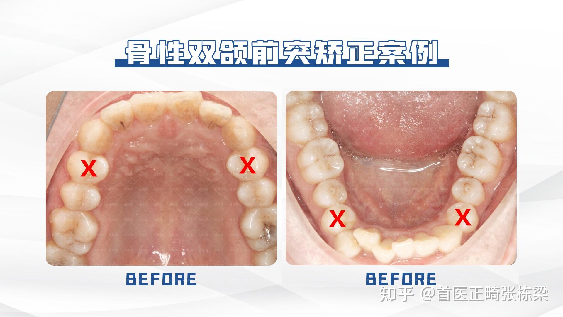 成人骨性嘴突下巴後縮牙齒矯正還有機會嗎