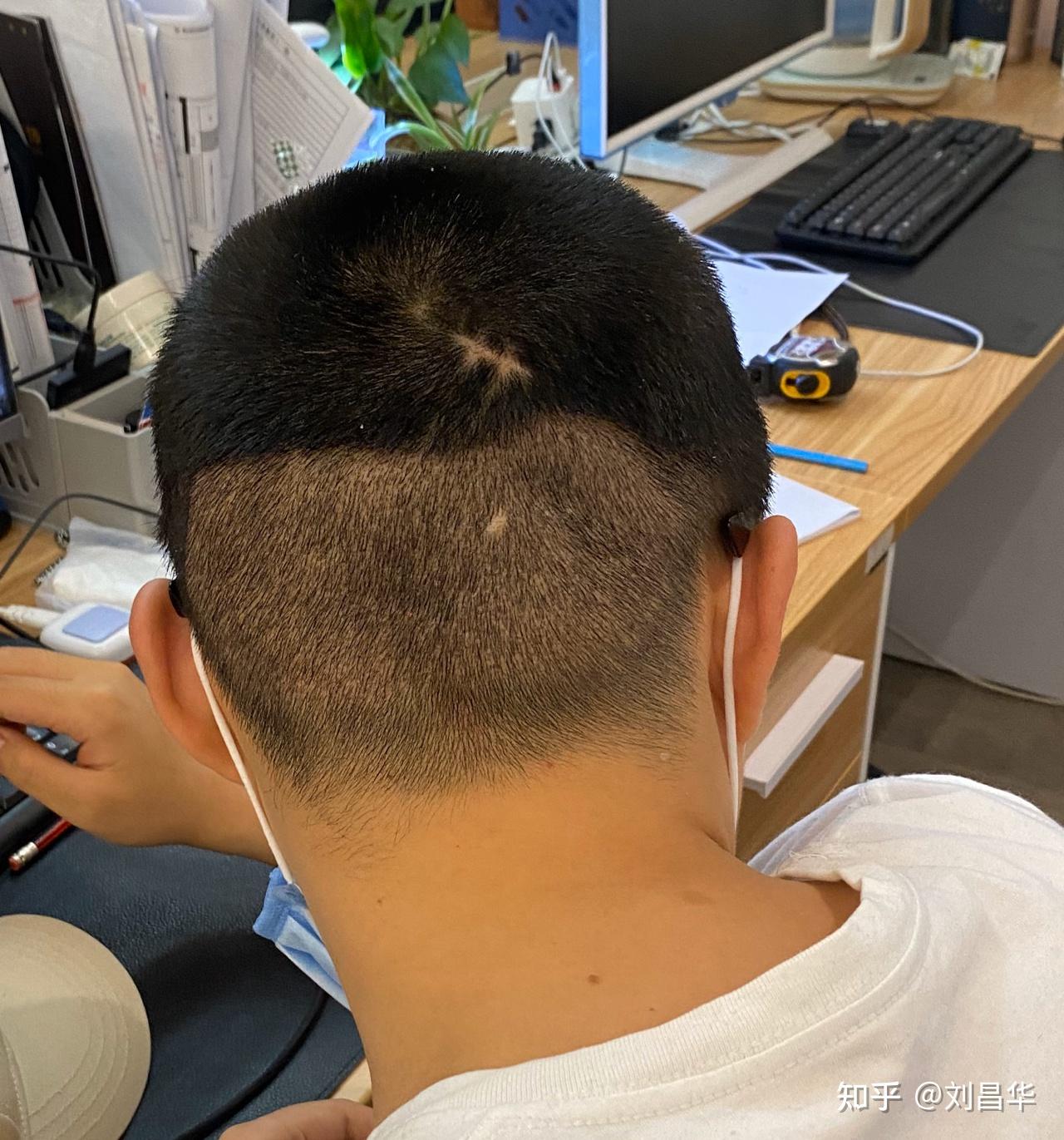 第四天植发区很痒怎么办(植发后四天第一次洗头怎么洗)