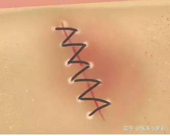 为什么说隆胸疤痕做不到完全没有