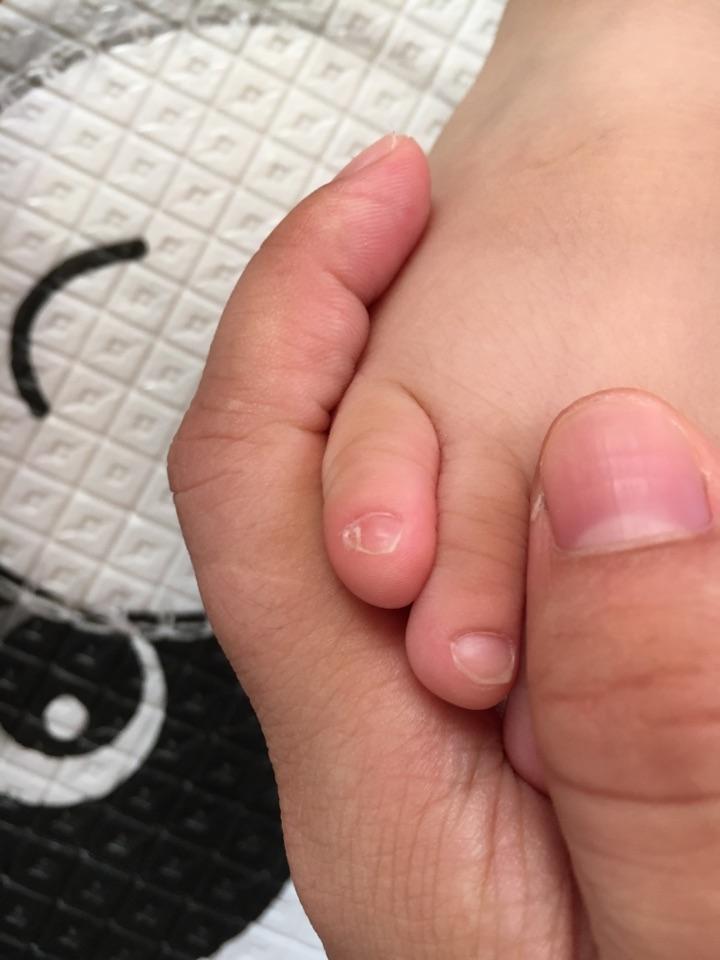 脚的小拇趾趾甲分两半,有科学解释吗? - 知乎