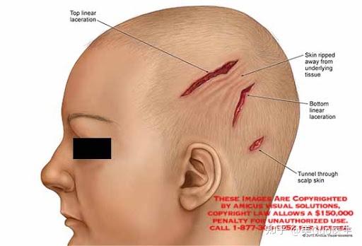 头破血流 并不可怕 知乎
