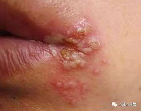 口角炎分类中感染性比较常见,主要由细菌,真菌,病毒等病原微生物引起.