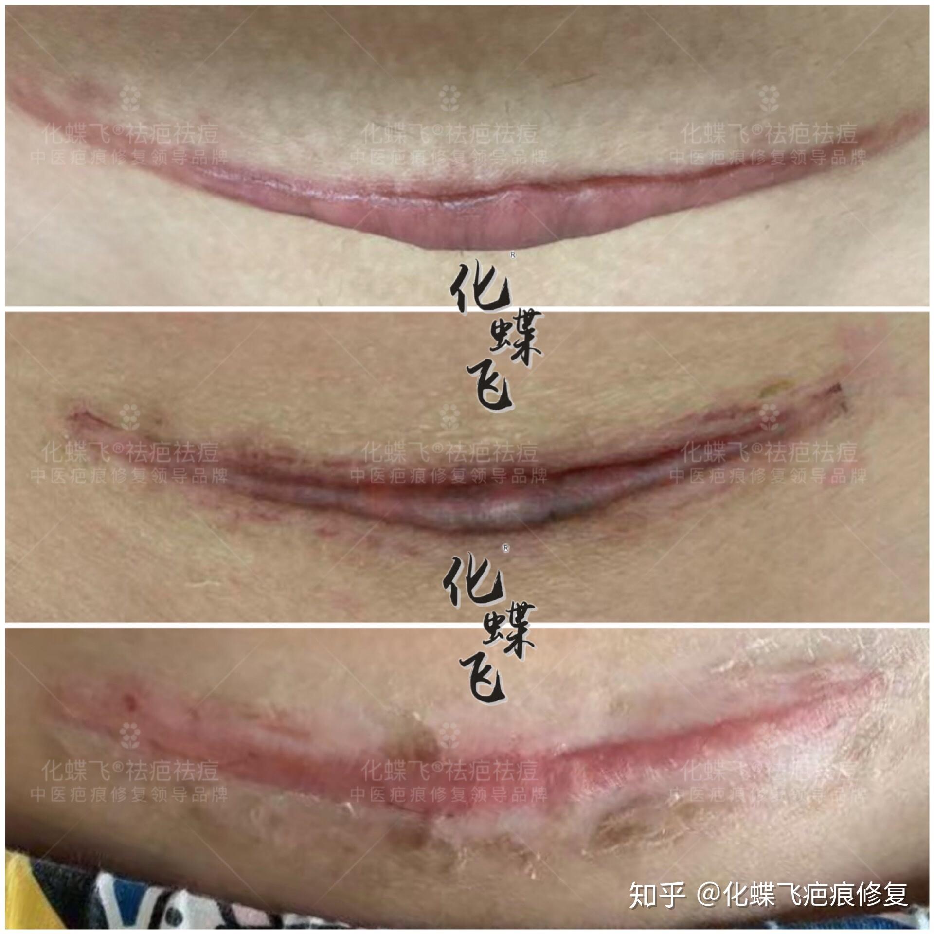 浙江紹興,美女寶媽,由於疤痕體質,剖腹產後增生非常嚴重,又疼又癢.