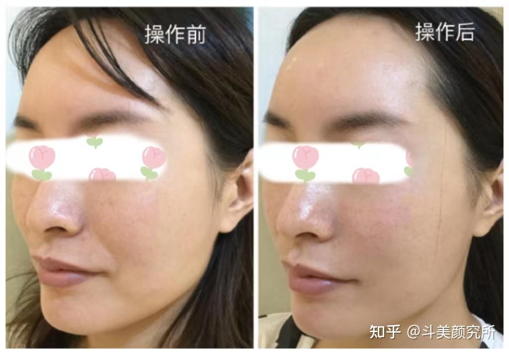 面部颜值“纹”题 | 静态纹和动态纹傻傻分不清楚？这篇文章帮你轻松搞定！ - 知乎