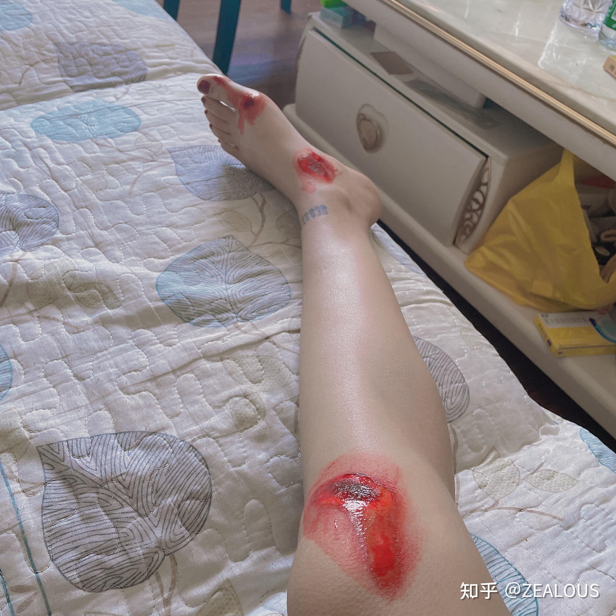 女生骑车摔伤腿的照片图片