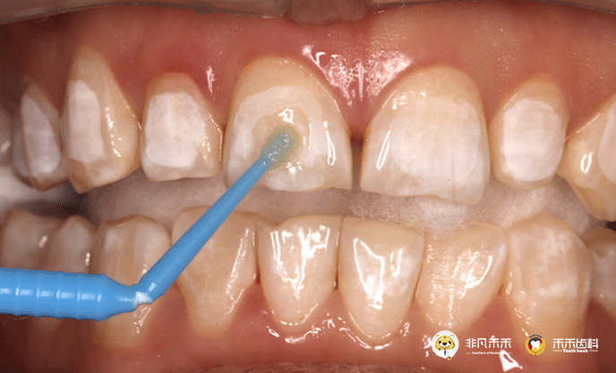 教授经验托槽粘接间接粘接技术下篇