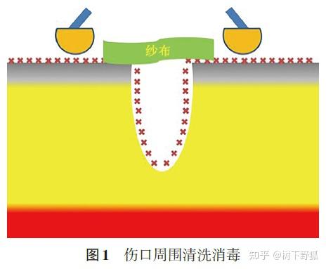 急诊开放性伤口清创缝合术专家共识 的理解应用112