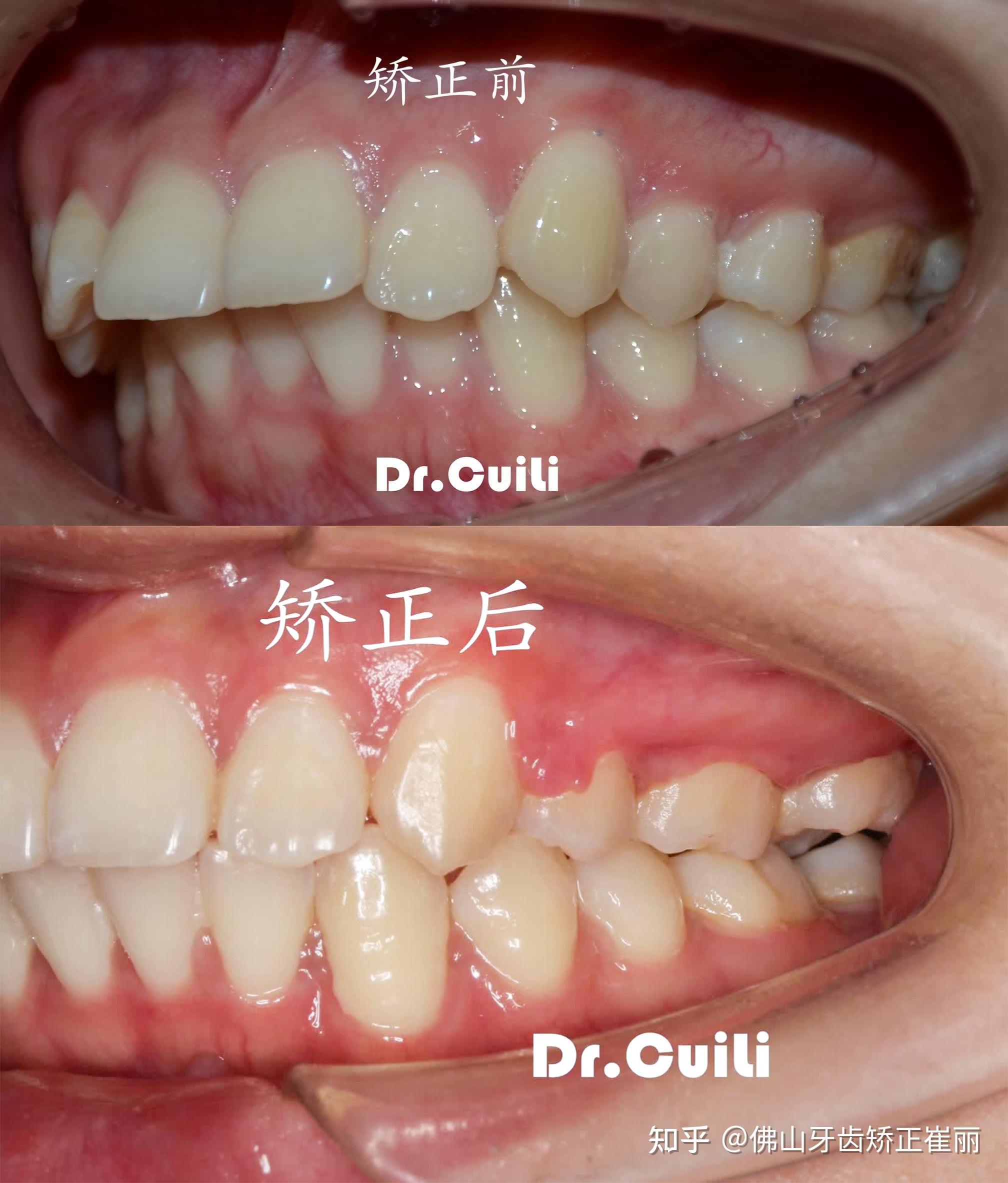 成都牙齿矫正｜深覆颌、深覆盖、牙列拥挤、双颌前突案例分享 - 知乎