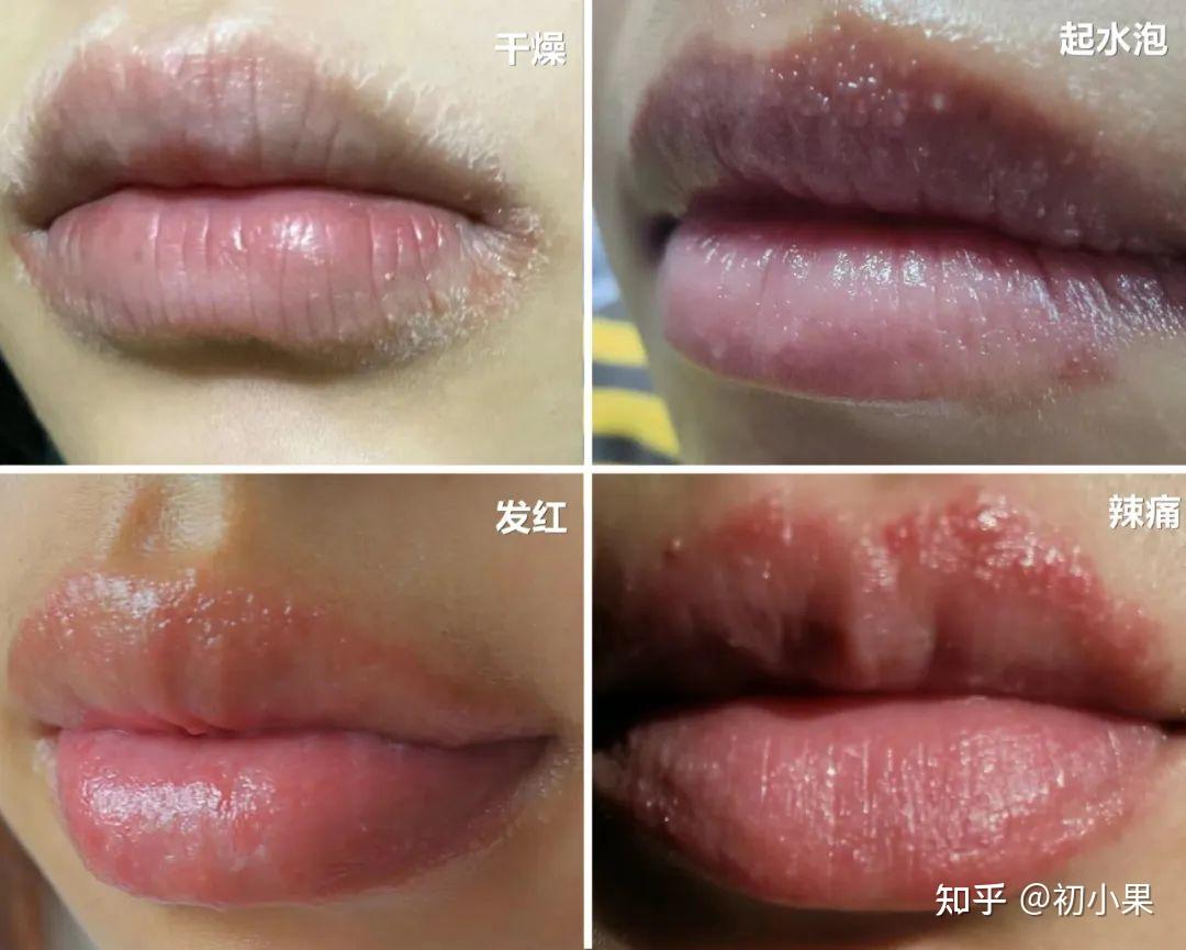 唇炎不可怕,反反复复才可怕 - 知乎