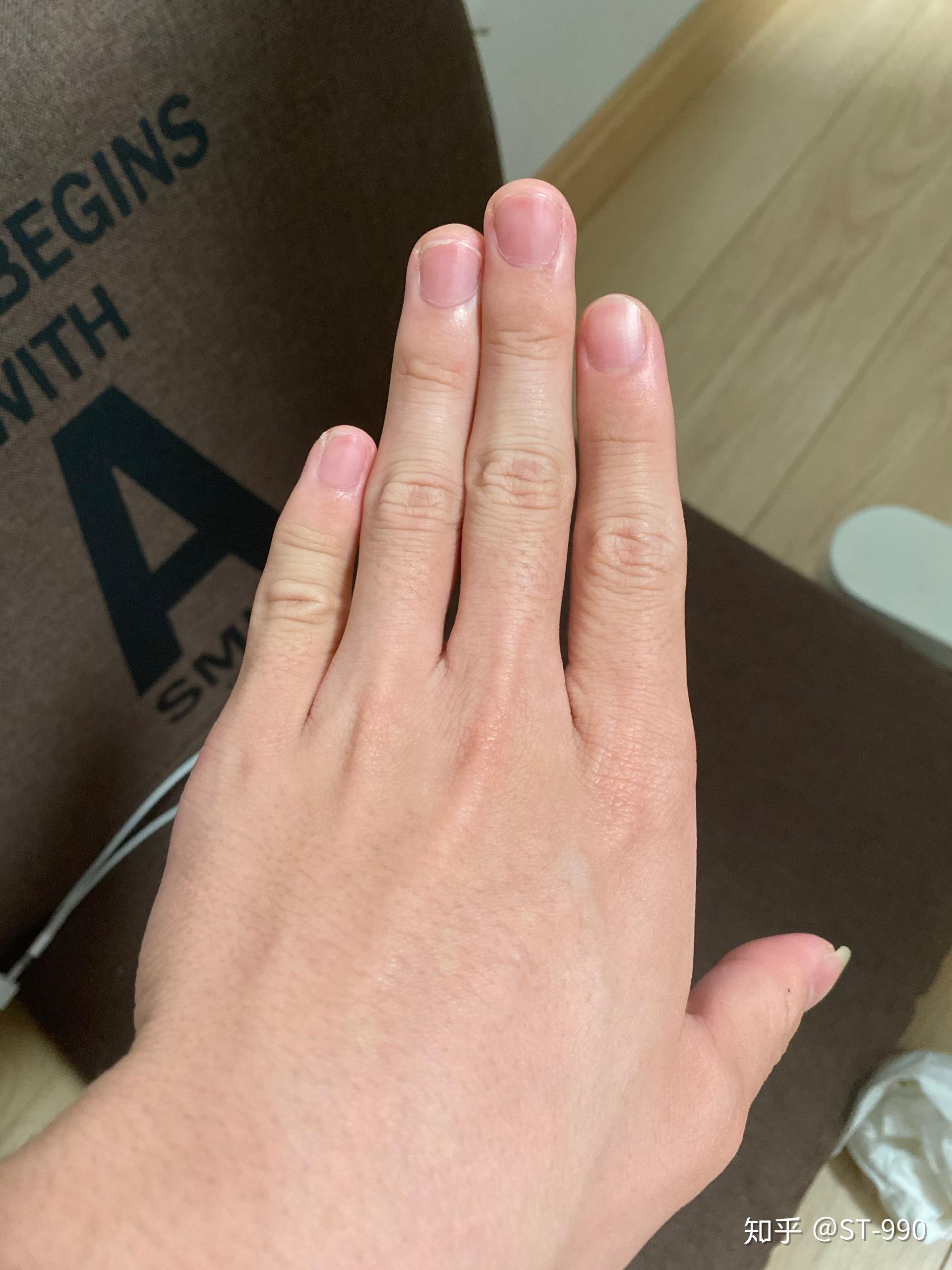 左手小拇指受过伤短一点能学好吉他吗