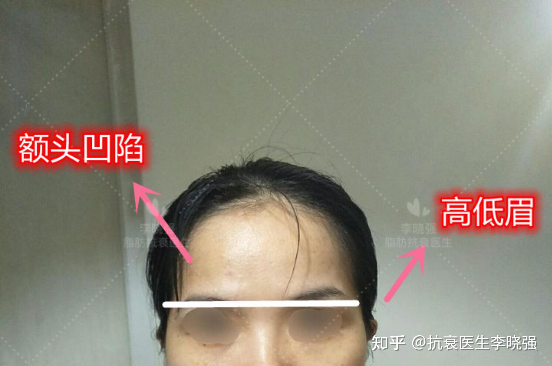 大家好我这个是太阳穴额头凹陷还是颧骨高啊?