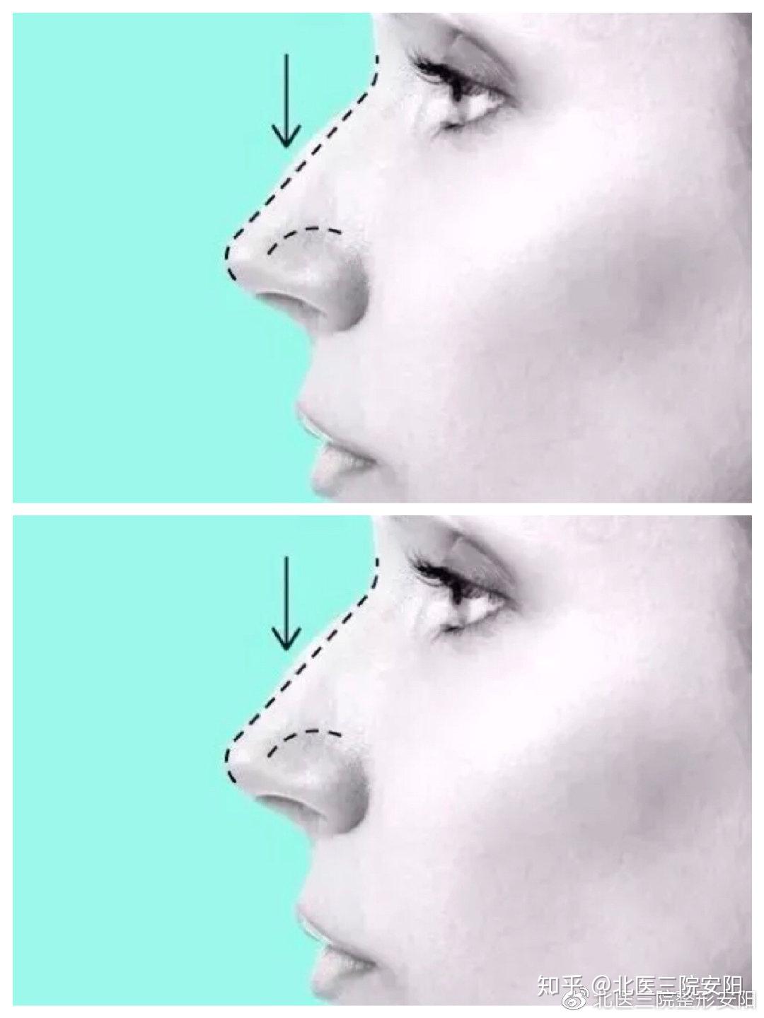 完美鼻型标准总结什么样的鼻子最好看？好看的鼻子都符_圈子-新氧美容整形