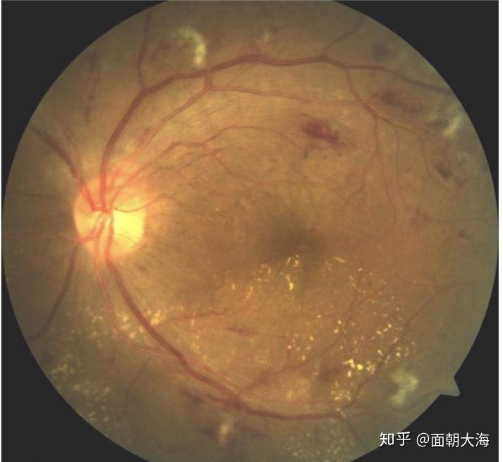 眼底棉绒斑图片图片