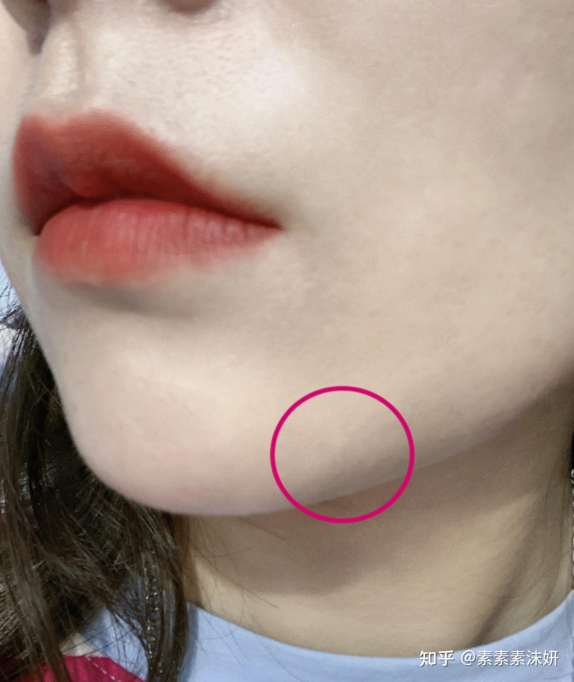 手术切痣过程和术后恢复详图