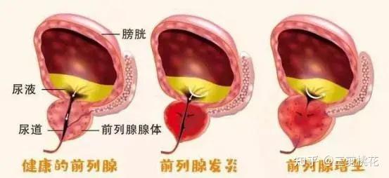 前列腺增生是什麼意思